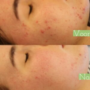 voor en na acnetherapie